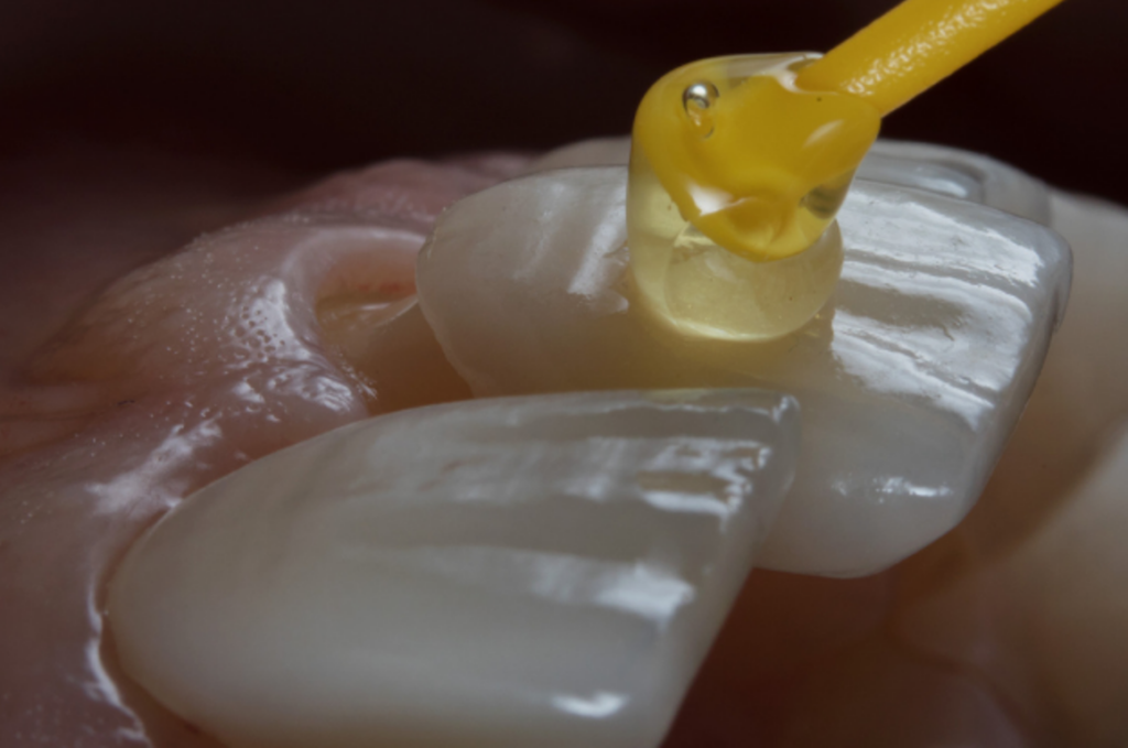 porcelain_veneers_Laguna_Hills_dentist