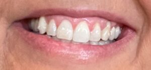 Reveal_Aligners_dentist_Laguna_Hills
