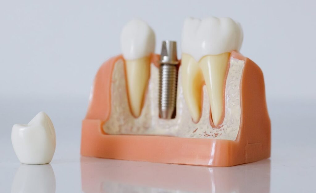 dental_implants_Laguna_Hills_dentist
