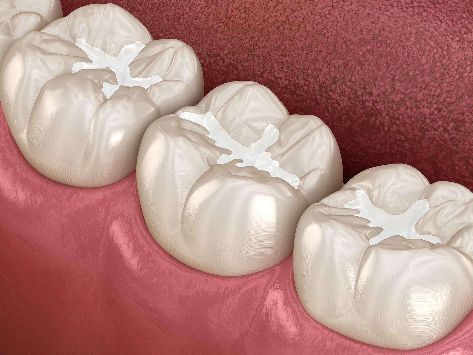 Fillings