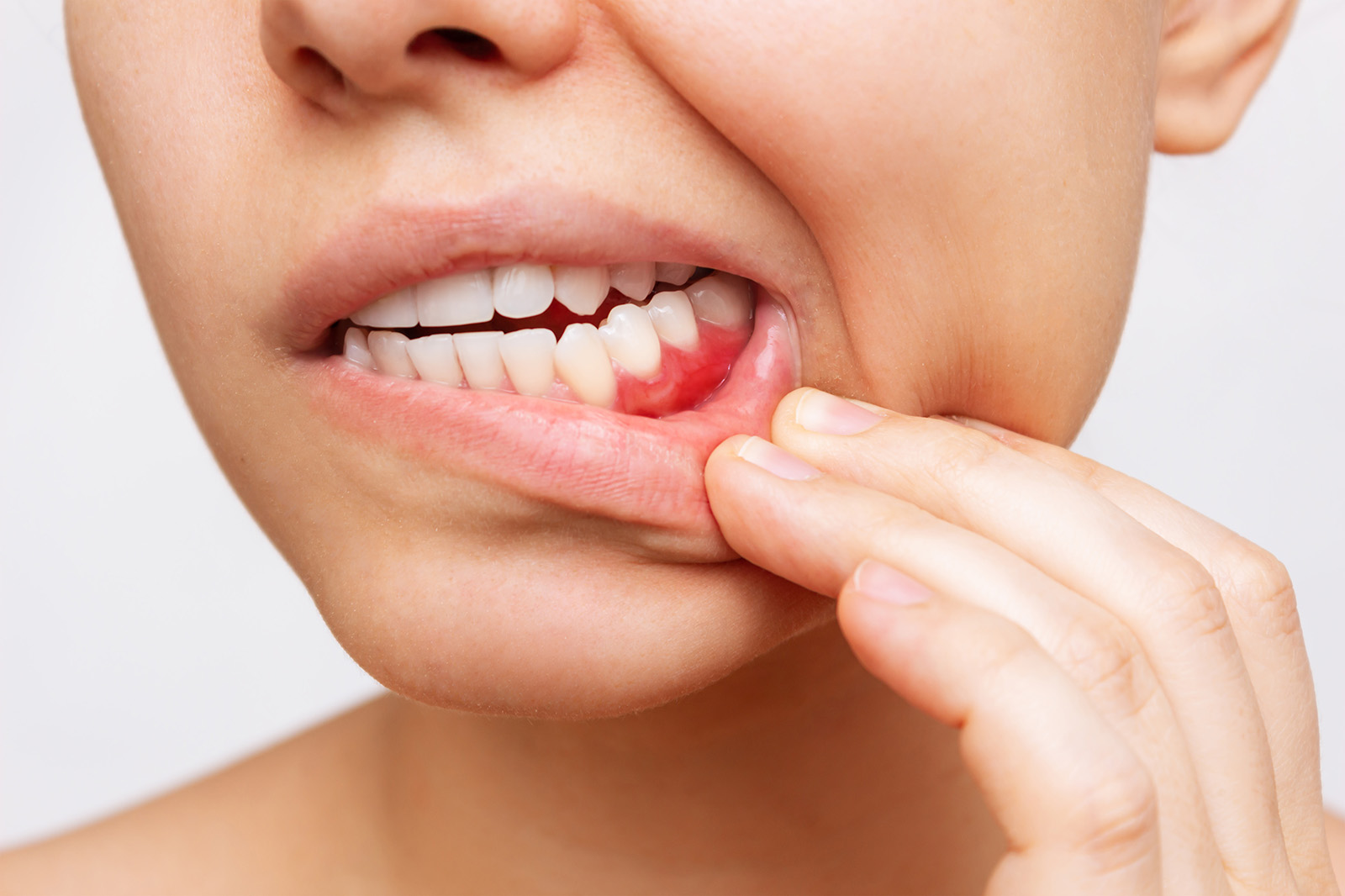 Red inflamed gums